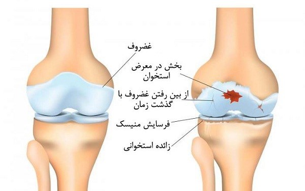 مراجعه به پزشک برای زانو درد